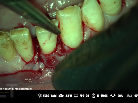 Laseroterapia mikrochirurgiczna w periodontologii
