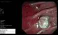 Endoskopowa ampulektomia gruczolaka brodawki dwunastniczej mniejszej