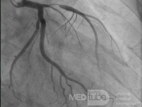 Koronarografia - zwężenie LAD w odcinku proksymalnym