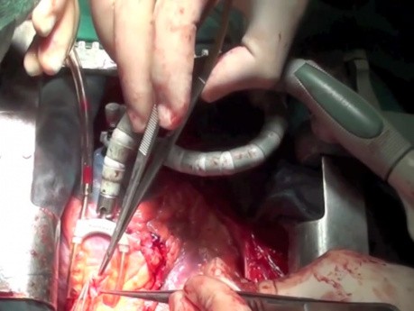 Pomostowanie tętnic wieńcowych bez użycia krążenia pozaustrojowego