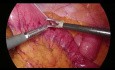 Wytworzenie jejunostomii odżywczej metodą laparoskopową