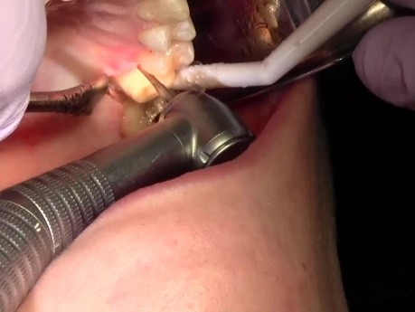 Wydłużenie korony klinicznej zęba (#14)