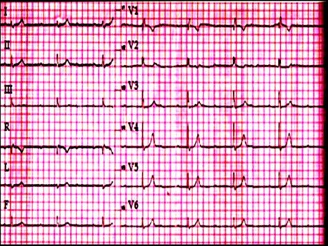 EKG quiz 1 - pacjent ze zmęczeniem i zawrotami głowy