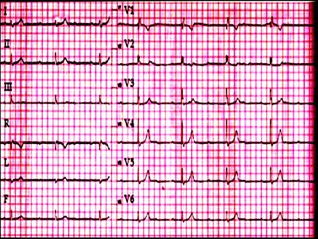 EKG quiz 1 - pacjent ze zmęczeniem i zawrotami głowy