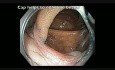 Okrężnica wstępująca - blizna po endoskopowej mukozektomii