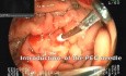 Przezskórne leczenie gastrostomii - endoultrasonografia (EUS)