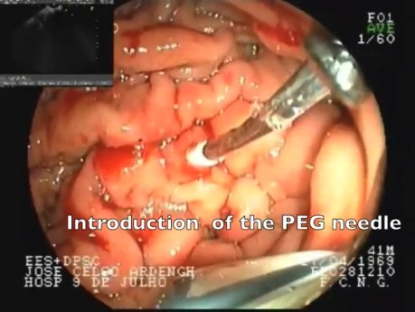 Przezskórne leczenie gastrostomii - endoultrasonografia (EUS)