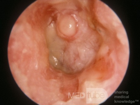 Ciężka ostra grzybica ucha z owrzodzeniem przewodu słuchowego (kropidlak czarny)