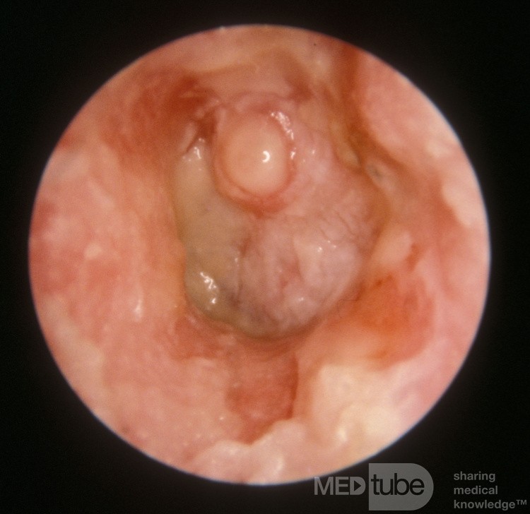 Ciężka ostra grzybica ucha z owrzodzeniem przewodu słuchowego (kropidlak czarny)