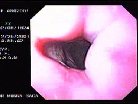 Krwotok - podwiązywanie żylaków przełyku (gumowa opaska) - obraz wpustu żołądka po założeniu zgłębnika Minnesota