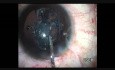 Kapsulotomia z użyciem Plasma Blade w zaćmie podwichniętej 