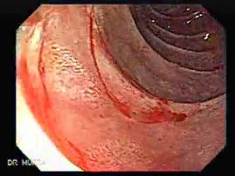 Gruczolakorak wpustu żołądka - bliższe spojrzenie na brodawkę Vatera, część 2