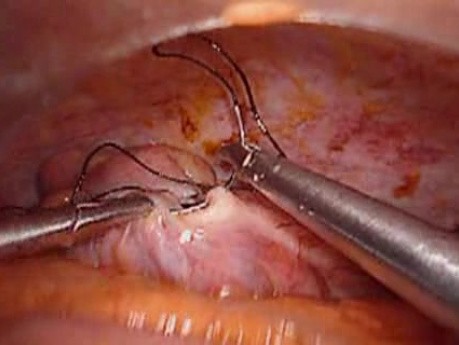 Perforacja okrężnicy z zapaleniem otrzewnej - laparoskopia (18 z 46)