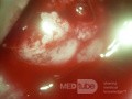 Rak gruczołowy szyjki macicy (Carcinoma Glandulare Colli Uteri)