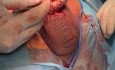Szew wewnątrz tubingu implantu protezy prącia