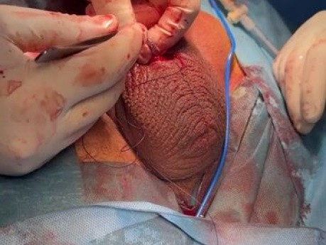 Szew wewnątrz tubingu implantu protezy prącia