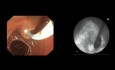 Endoskopowa cholangiopankreatografia wsteczna (ECPW) u pacjenta po resekcji Billroth II