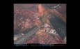 Robotyczna pankreatoduodenektomia z powodu gruczolakoraka przewodowego 