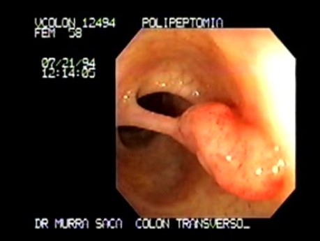 Duży uszypułowany polip - polipektomia typu snare (1 z 5)