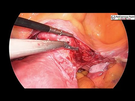 Całkowita laparoskopowa histerektomia z podaniem zieleni indocyjaniny