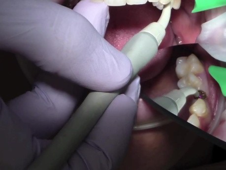 Laser stomatologiczny Ivoclar Odyssey Navigator 