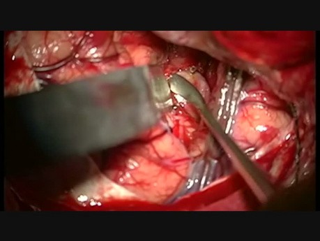 Olbrzymi wykrzepiony tętniak wrzecionowaty