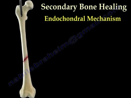 Mechanizm zrostu kości po złamaniu - część II