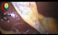 Przypadek cholecystektomii laparoskopowej, pierwszy stopień skali Nassara