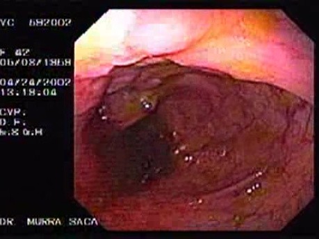 Choroba Leśniowskiego - Crohna - endoskopia (6 z 28)