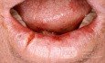 Rissige Lippe