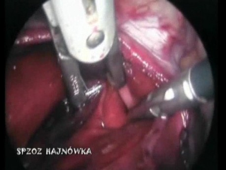 Uszkodzenie lewej jamy opłucnowej w trakcie laparoskopii