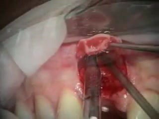 Złamany ząb 11 - górny prawy siekacz centralny