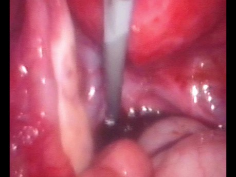 Endometrioma - cystektomia za pomocą cewnika Foleya
