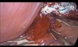 Laparoskopowa miotomia Hellera i fundoplikacja metodą Dora po nieudanym rozszerzeniu balonem