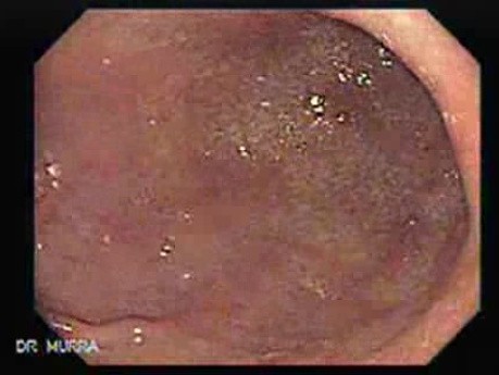 Rak jajnika z przerzutami do żołądka i dwunastnicy - przypadek 50-letniej kobiety