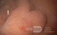 Nietypowy obraz polipów dna i trzonu żołądka w endoskopii. Chromoendoskopia. NET (3/6)