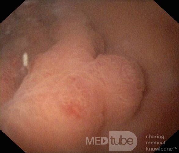 Nietypowy obraz polipów dna i trzonu żołądka w endoskopii. Chromoendoskopia. NET (3/6)