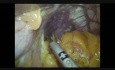 Trójtrokarowa laparoskopowa rękawowa resekcja żołądka