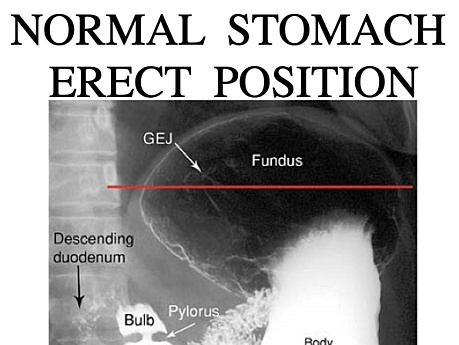 Chirurgia radiologiczna - choroby żołądka i dwunastnicy 