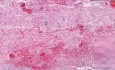 Jelito grube - zawał krwotoczny