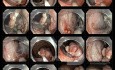 Płaska zmiana o morfologii LST – G resekcja w technice endoskopowej dyssekcji podśluzówkowej