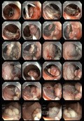 Płaska zmiana o morfologii LST – G resekcja w technice endoskopowej dyssekcji podśluzówkowej