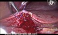 Kontrola krwawienia łożyska naczyniowego pęcherzyka żółciowego
