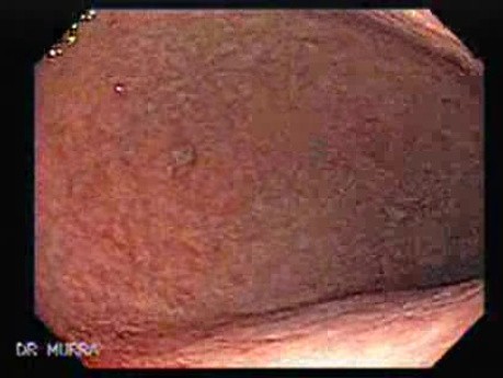 Rak gruczołowy trzonu i dna żołądka (4 z 4)