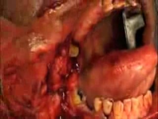 Operacja przyzwojaka niechromochłonnego kłębka tętnicy szyjnej