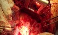 Traumatic Aortic Transection