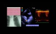 Przypadek koarktacji Aorty: dyskusja na temat EKG, badania echokardiograficznego i leczenia.