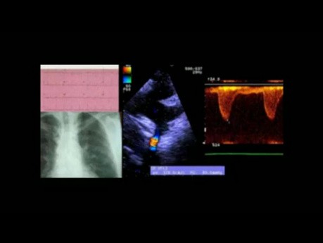 Przypadek koarktacji Aorty: dyskusja na temat EKG, badania echokardiograficznego i leczenia.