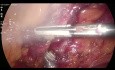 Laparoskopowa resekcja zgięcia esiczo-odbytniczego z uruchomieniem lewego zgięcia orkężnicy
