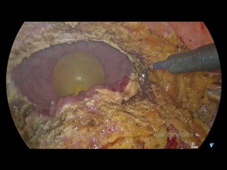 Laparoskopowa resekcja pęcherza moczowego